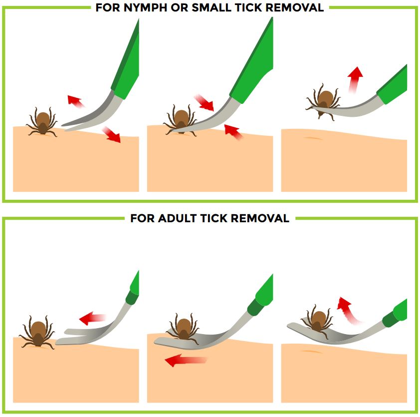 Tickcheck How To Safely Remove A Tick Tickcheck How To Safely Remove A Tick